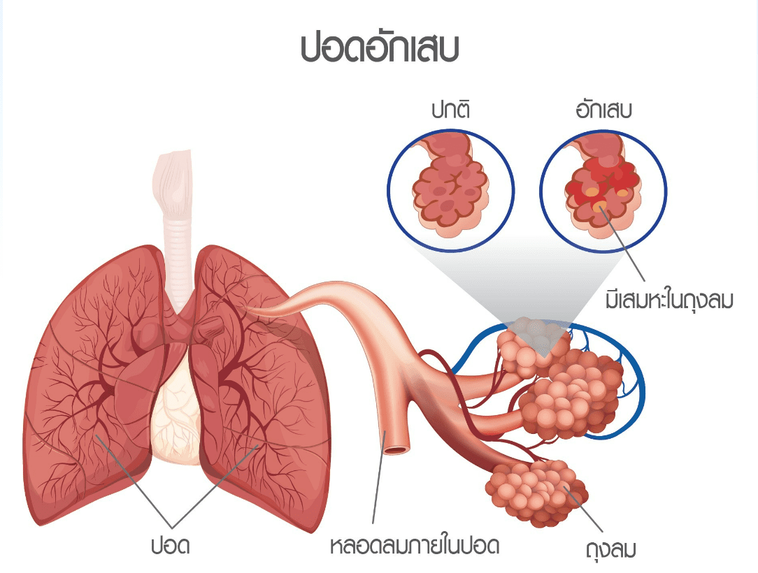 โรคปอดอักเสบ